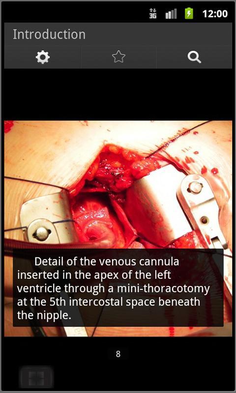 Aortic Surgery