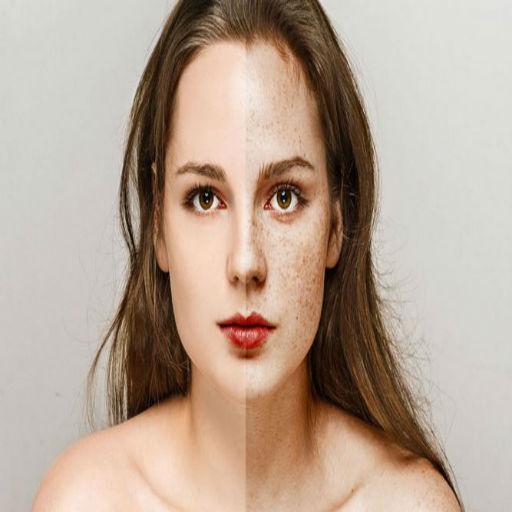 How to get ride of Freckles  (